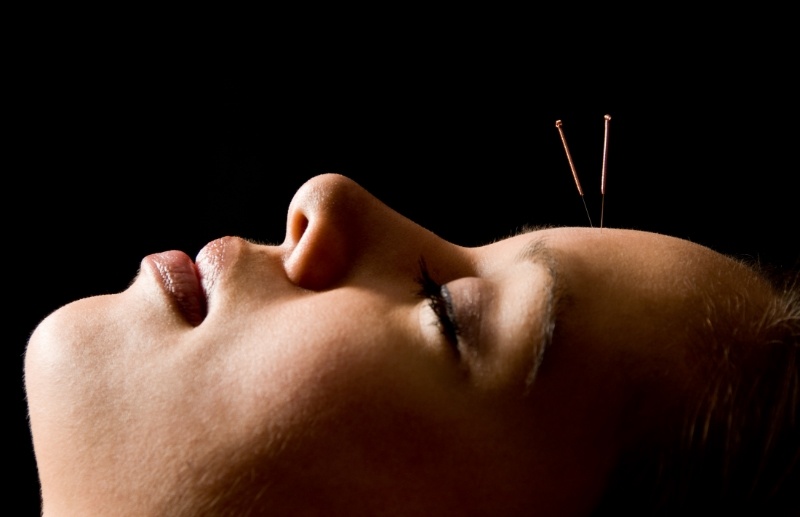 AcupuncturePatient-725805-edited